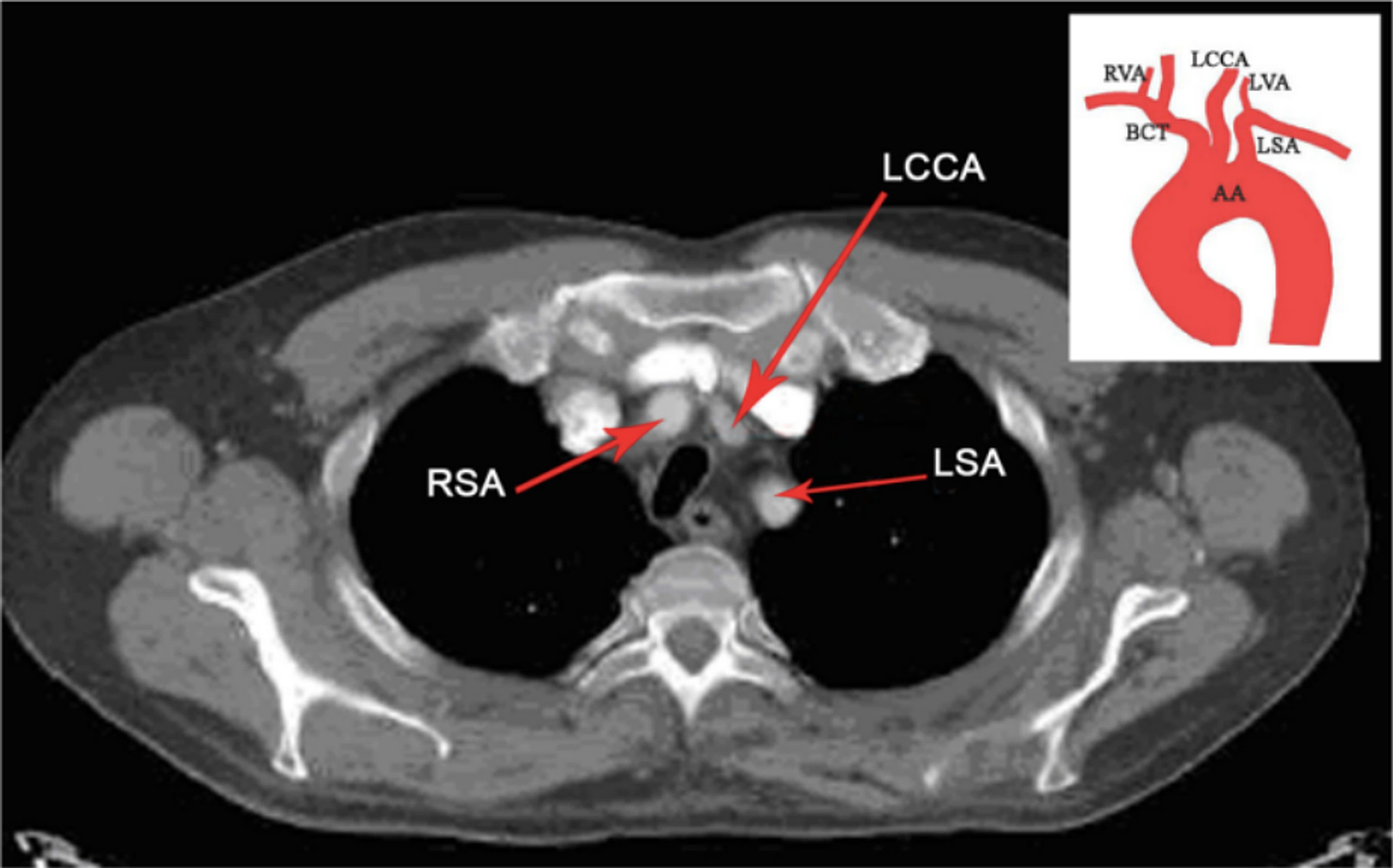 Cureus Anatomical Variations of the Aortic Arch A Computerized