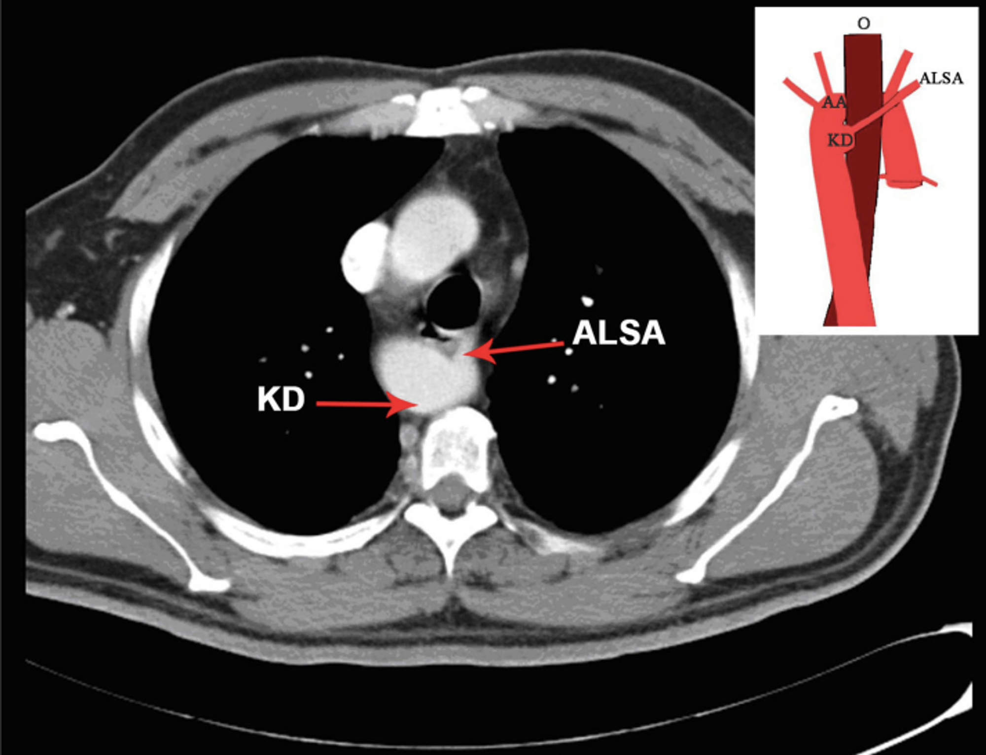 aortic arch ct