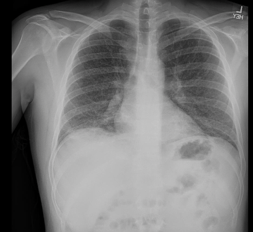 Cureus | Vape-Associated Pulmonary Injury (VAPI) Presenting With a ...