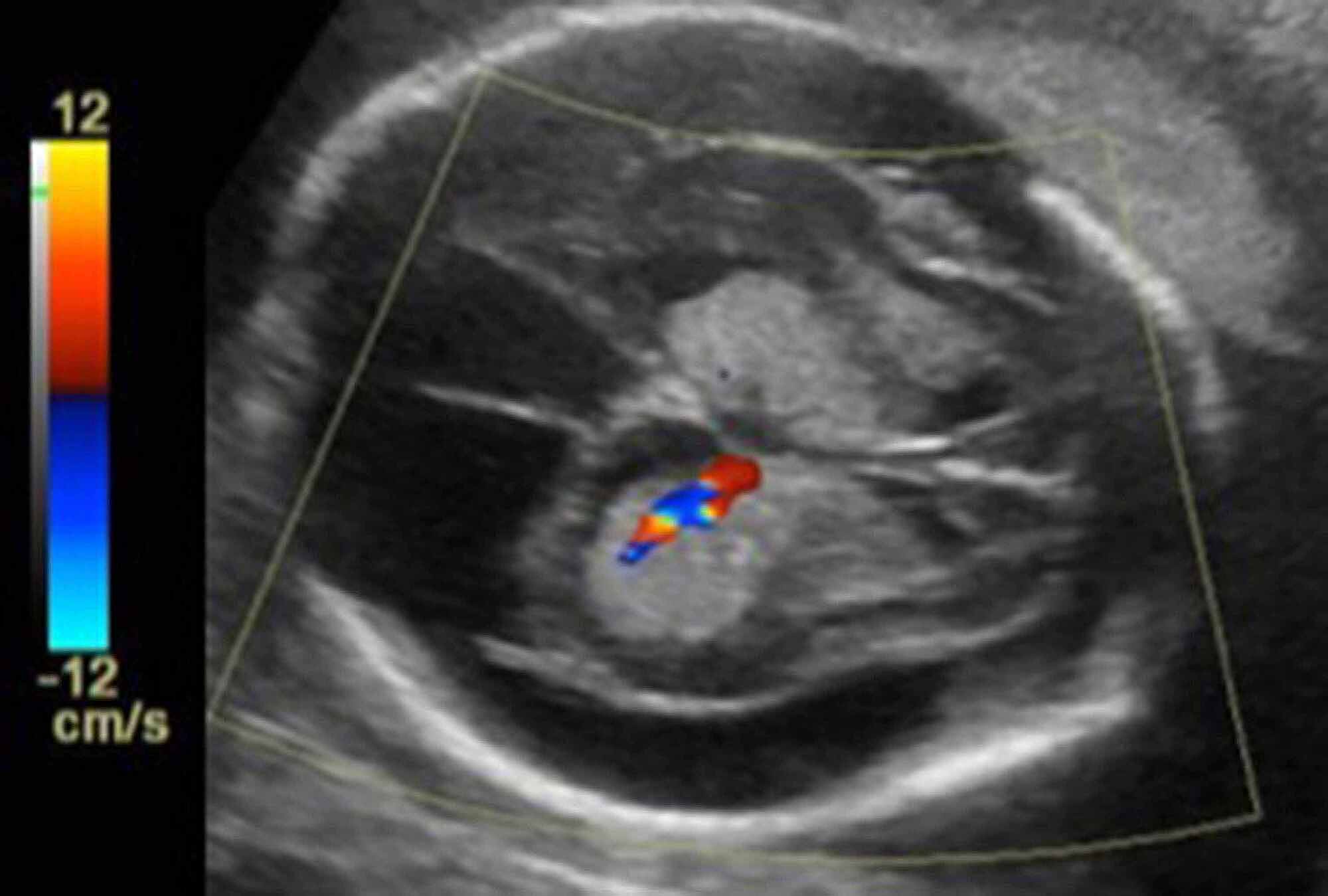 Cureus Bilateral Choroid Plexus Papillomas Diagnosed By Prenatal Ultrasound And Mri 