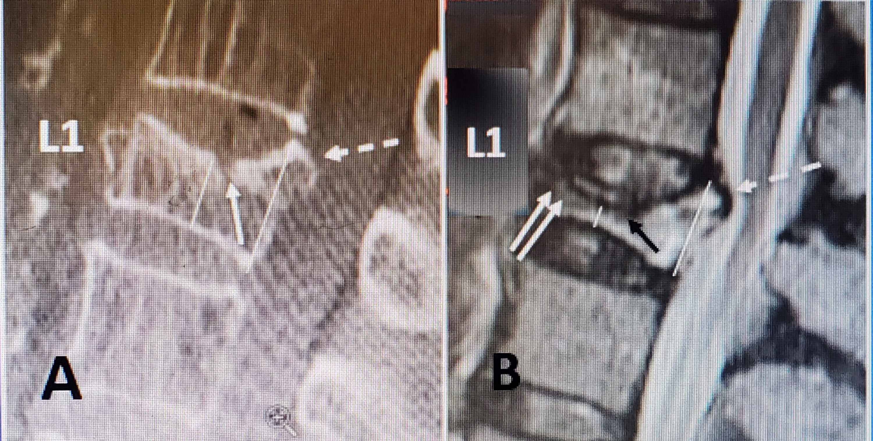 Cureus Reexpansion and Stabilization of Vertebra Plana Fractures