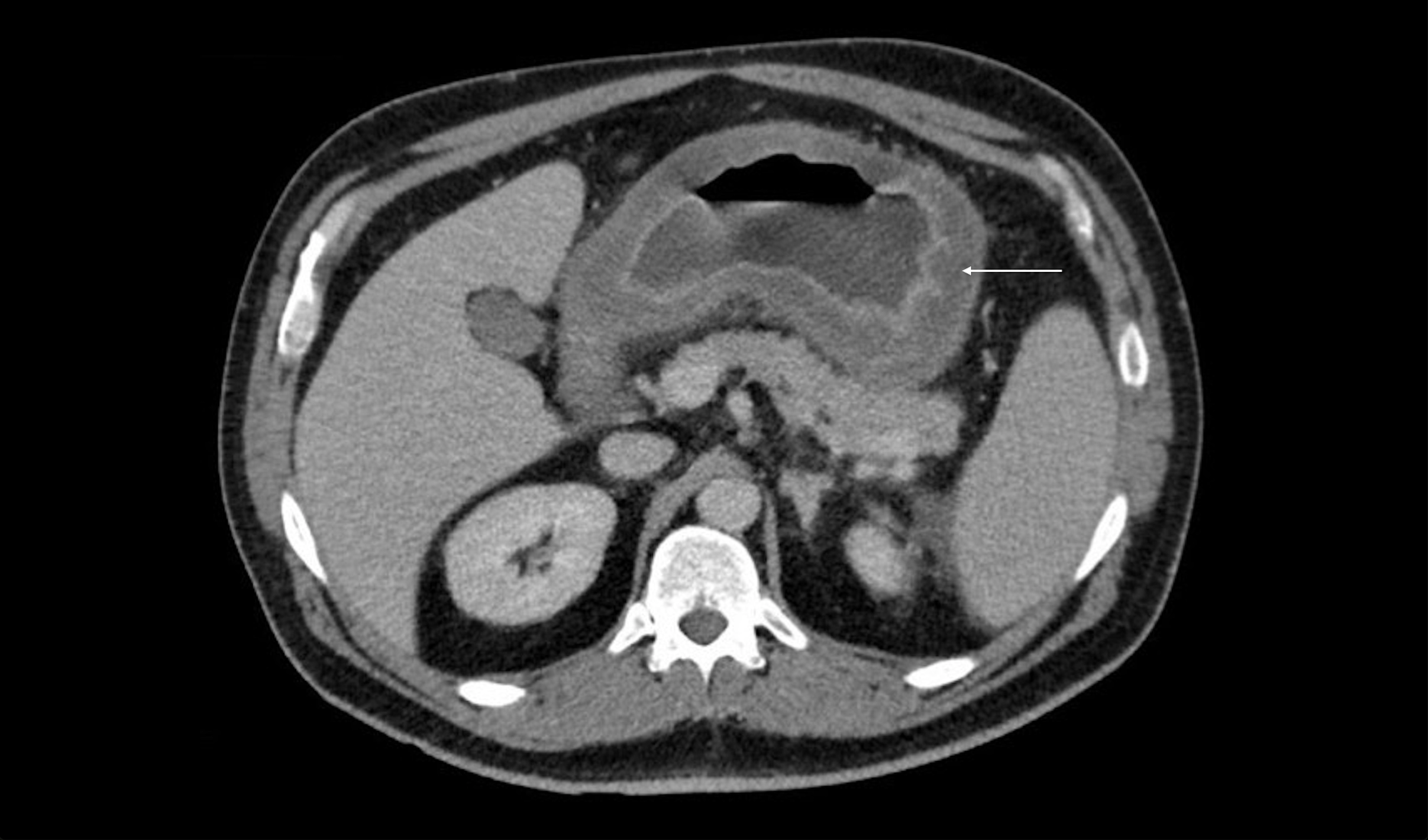 Cureus Phlegmonous Gastritis A Case Report of Successful Early