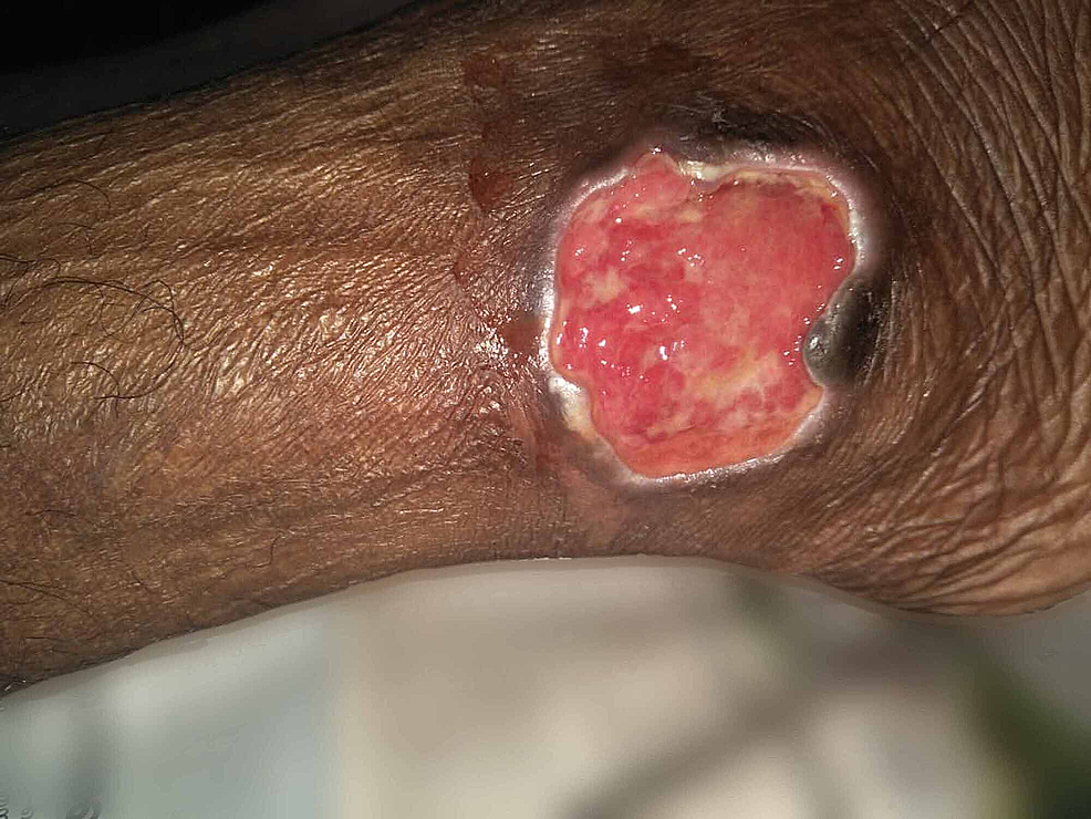 Large-non-healing-ulcer-over-the-lateral-malleolus