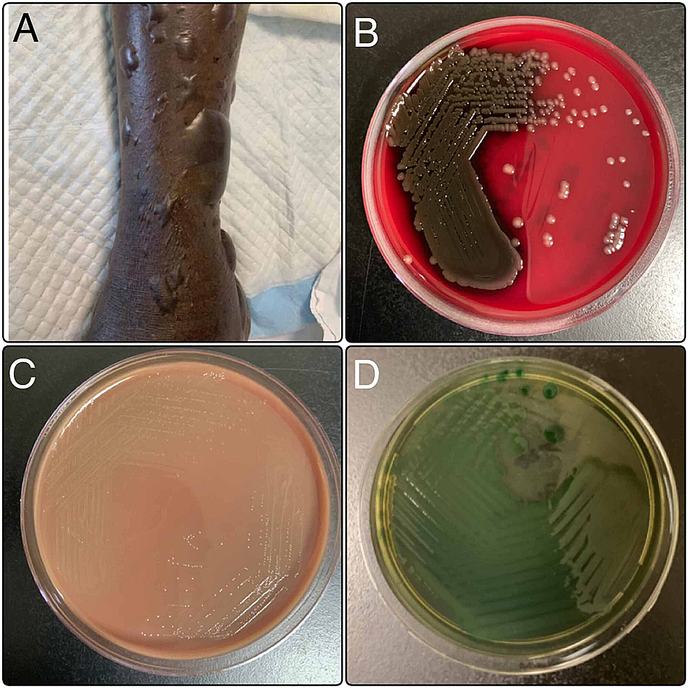 A.-Multiple-large-blisters-over-the-lower-limb;-B.-Blood-agar-plate-showing-grayish-white-and-glistening-colonies-suggestive-of-Vibrio;-C.-MacConkey-agar-plate-showing-non-lactose-fermenting-colonies-suggestive-of-Vibrio;-D.-Thiosulfate-citrate-bile-salts-sucrose-agar-showing-significant-growth-of-green-colonies-consistent-with-Vibrio-vulnificus