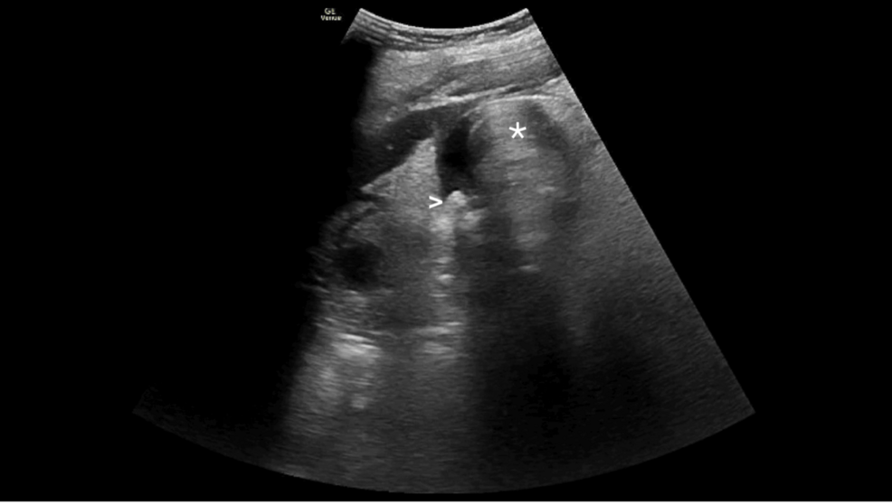 Point-of-Care Ultrasound for Emphysematous Cholecystitis Diagnosis | Cureus