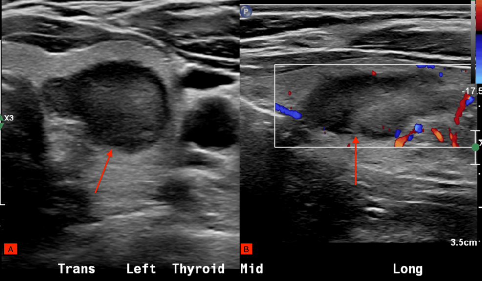 glp 1 thyroid nodule Mixed Medullary and Papillary Thyroid Carcinoma in a Patient on Tirzepatide