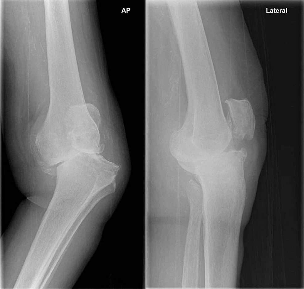 Cureus | Pushing the Surgical Limits: Primary Total Knee Arthroplasty ...