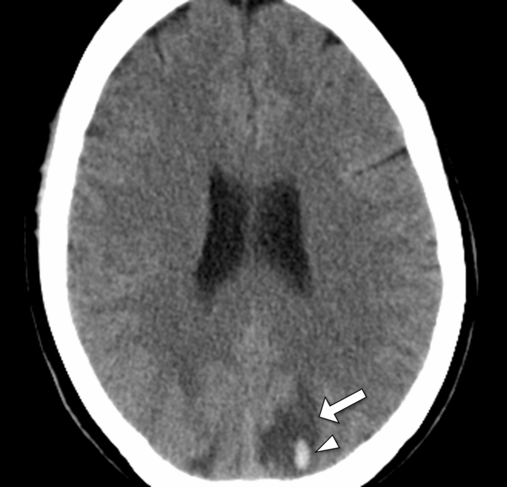 Acute Psychosis as the Initial Presentation of Systemic Lupus Erythematosus  Complicated by Posterior Reversible Encephalopathy Syndrome With  Hemorrhage: A Case Report | Cureus
