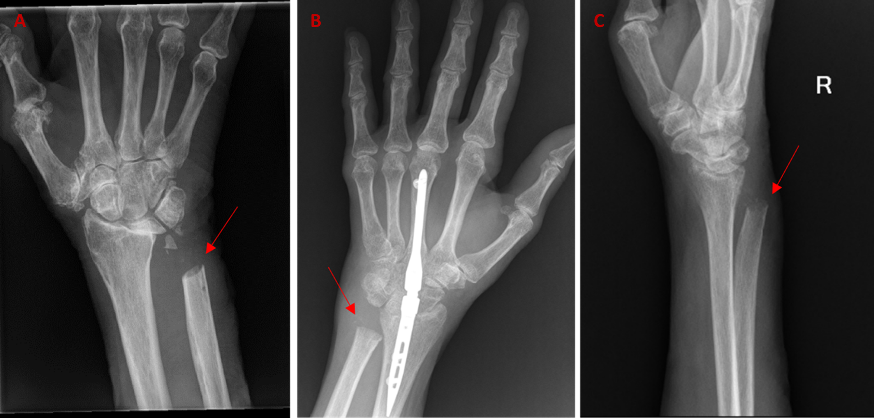 Cureus | Extensor Tendon Rupture After Distal Radioulnar Joint Surgery ...