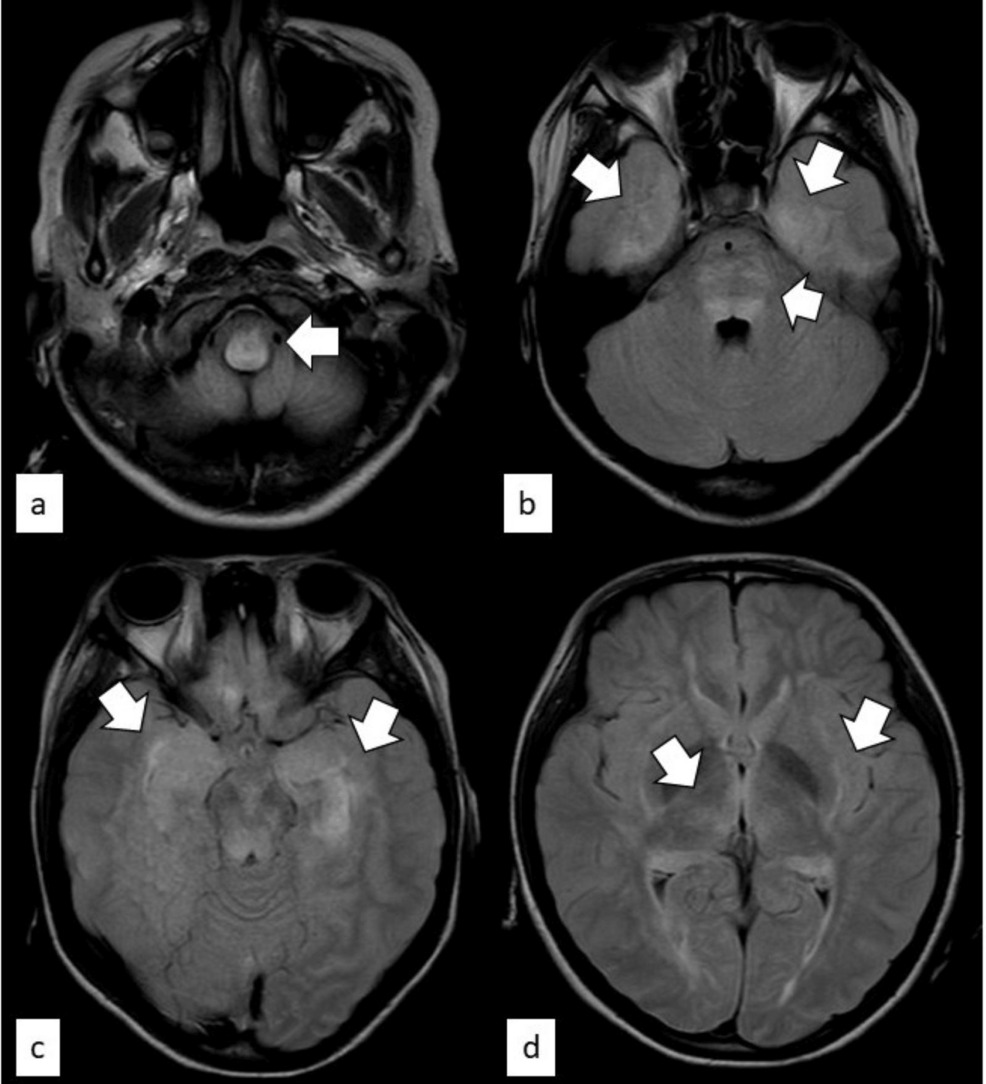 Neuropsychiatric Systemic Lupus Erythematosus Diagnosed Following
