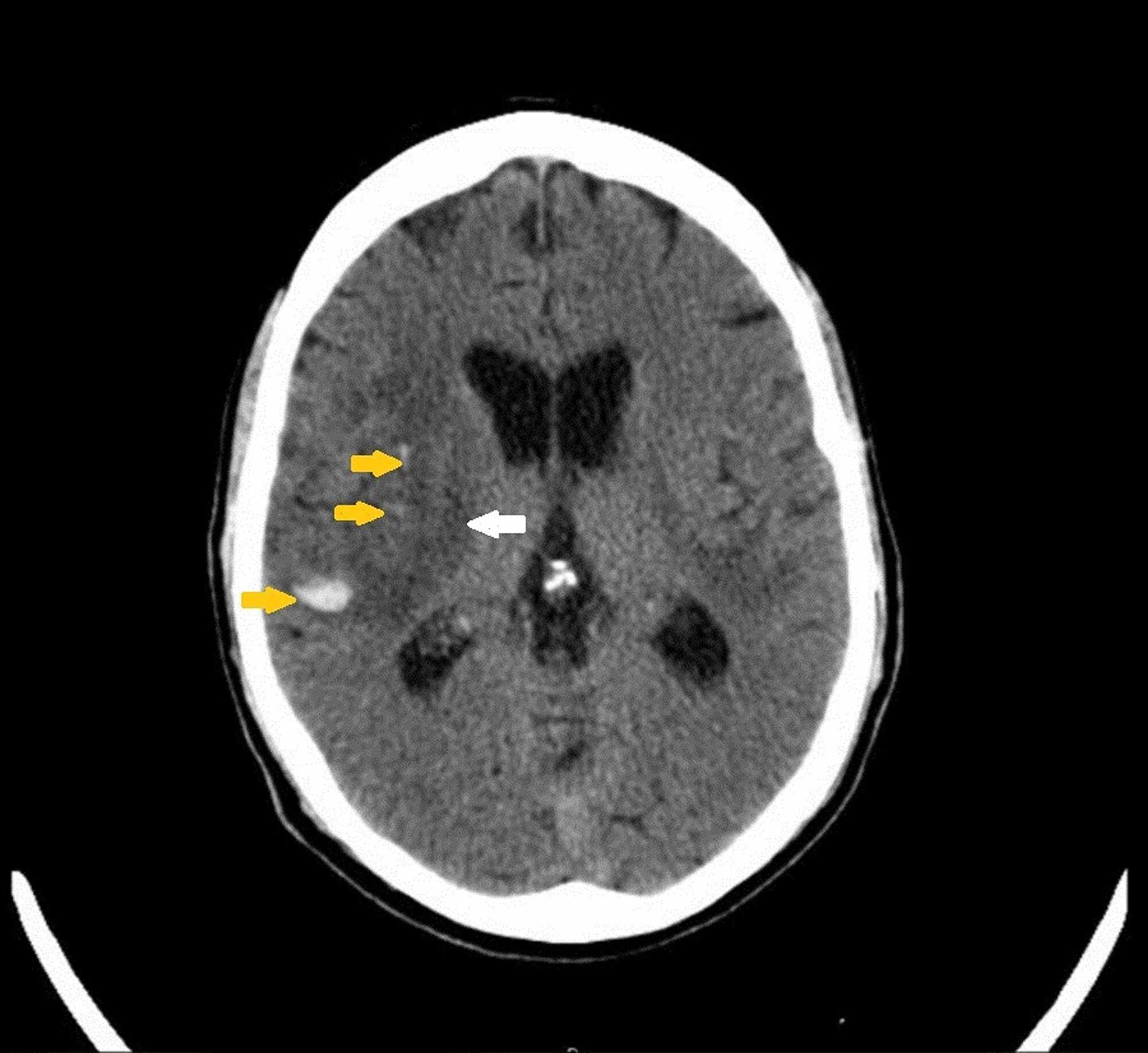 Cureus Primary Central Nervous System Vasculitis as an Unusual Cause