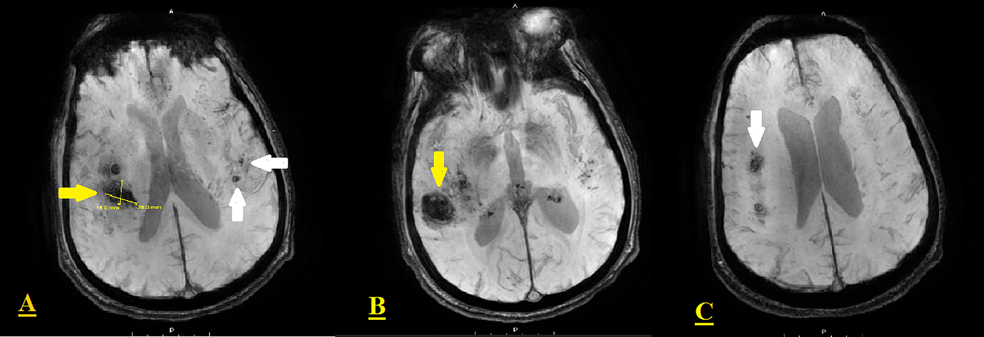 Vasculitis Mri Brain