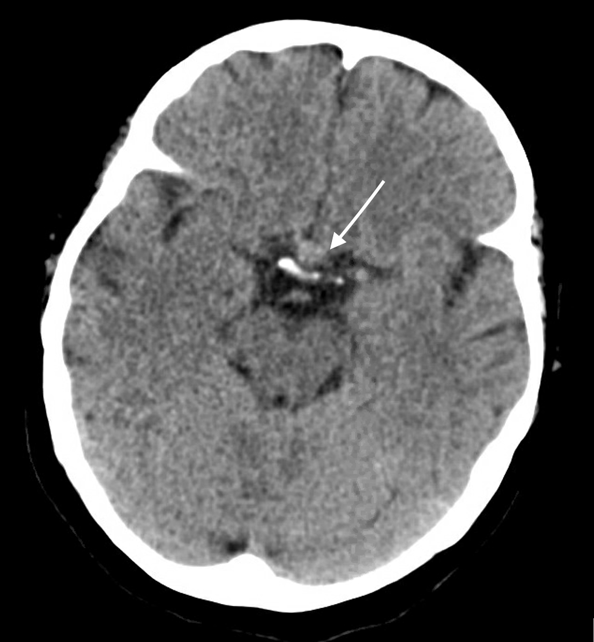 Cureus | Pituitary Apoplexy Attributed To COVID-19 Infection In The ...