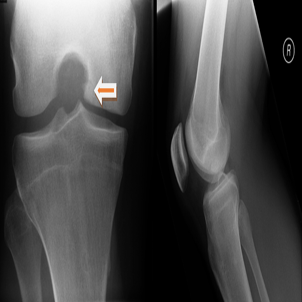 Cureus Microfracture Technique for Chronic Unstable Osteochondral Defect of Knee Case Report