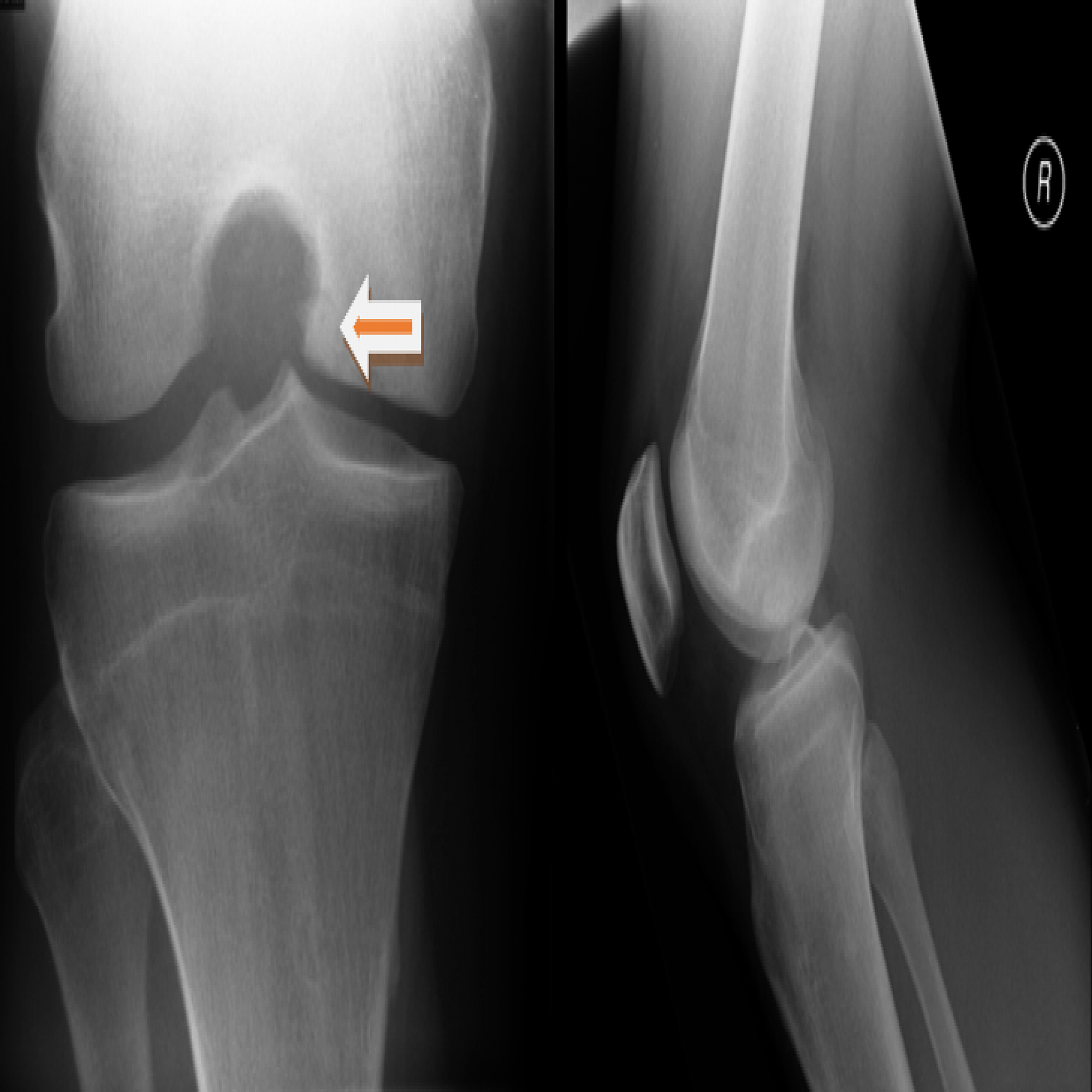 Cureus Microfracture Technique for Chronic Unstable