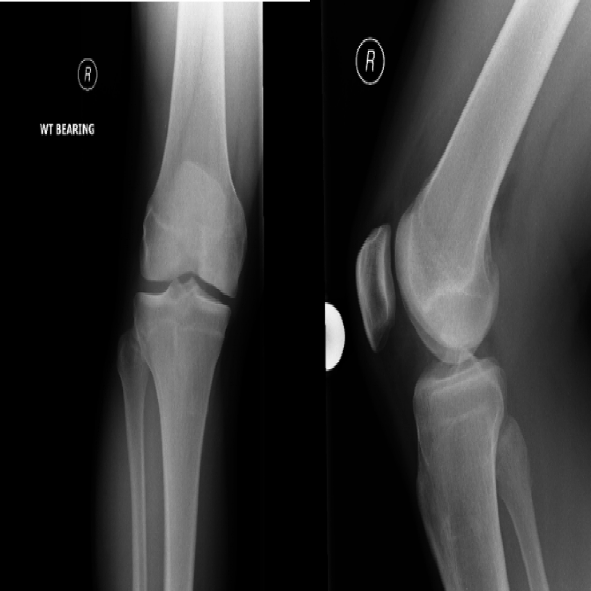 Cureus | Microfracture Technique for Chronic Unstable Osteochondral ...