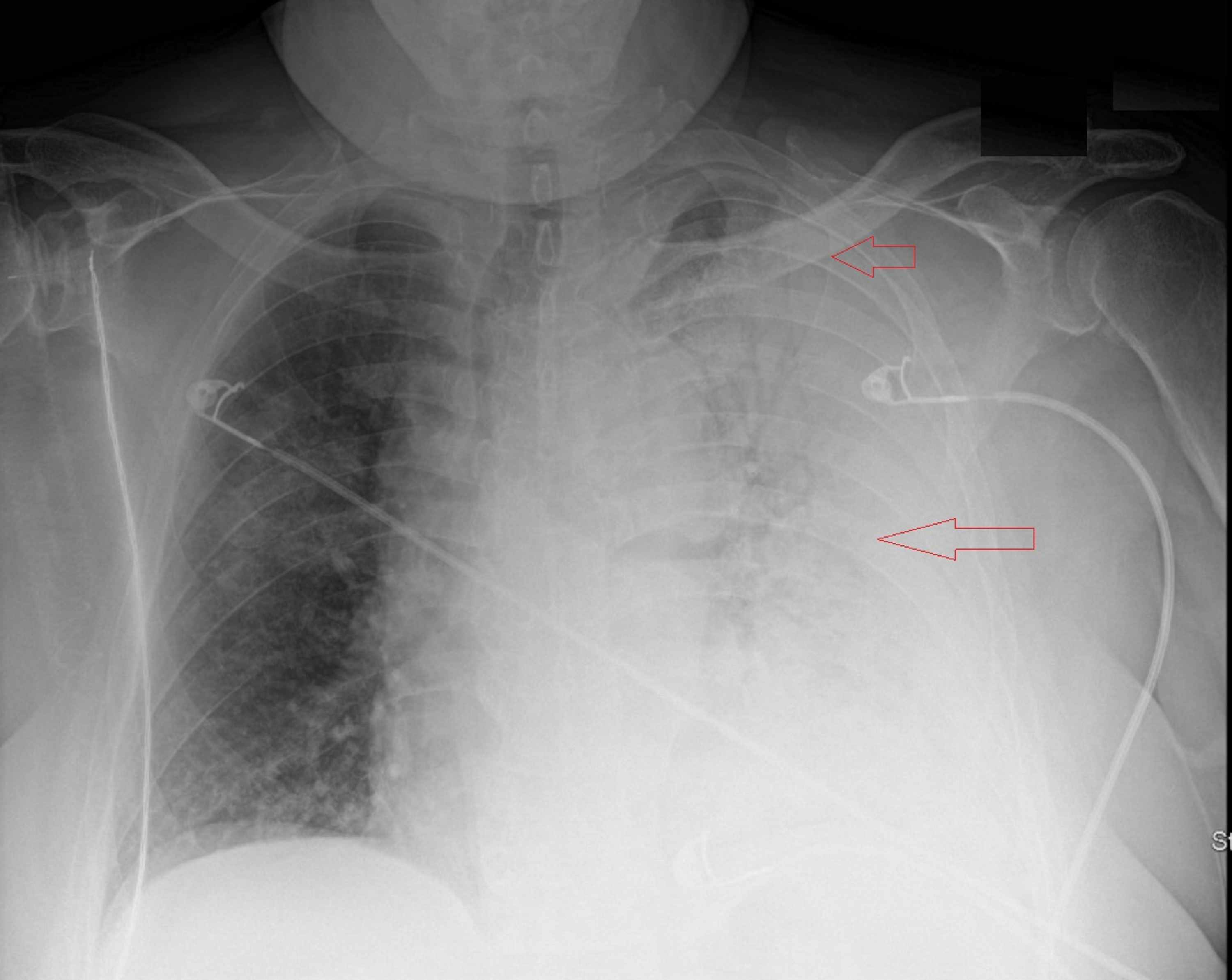 Legionella Pneumonia Chest X Ray