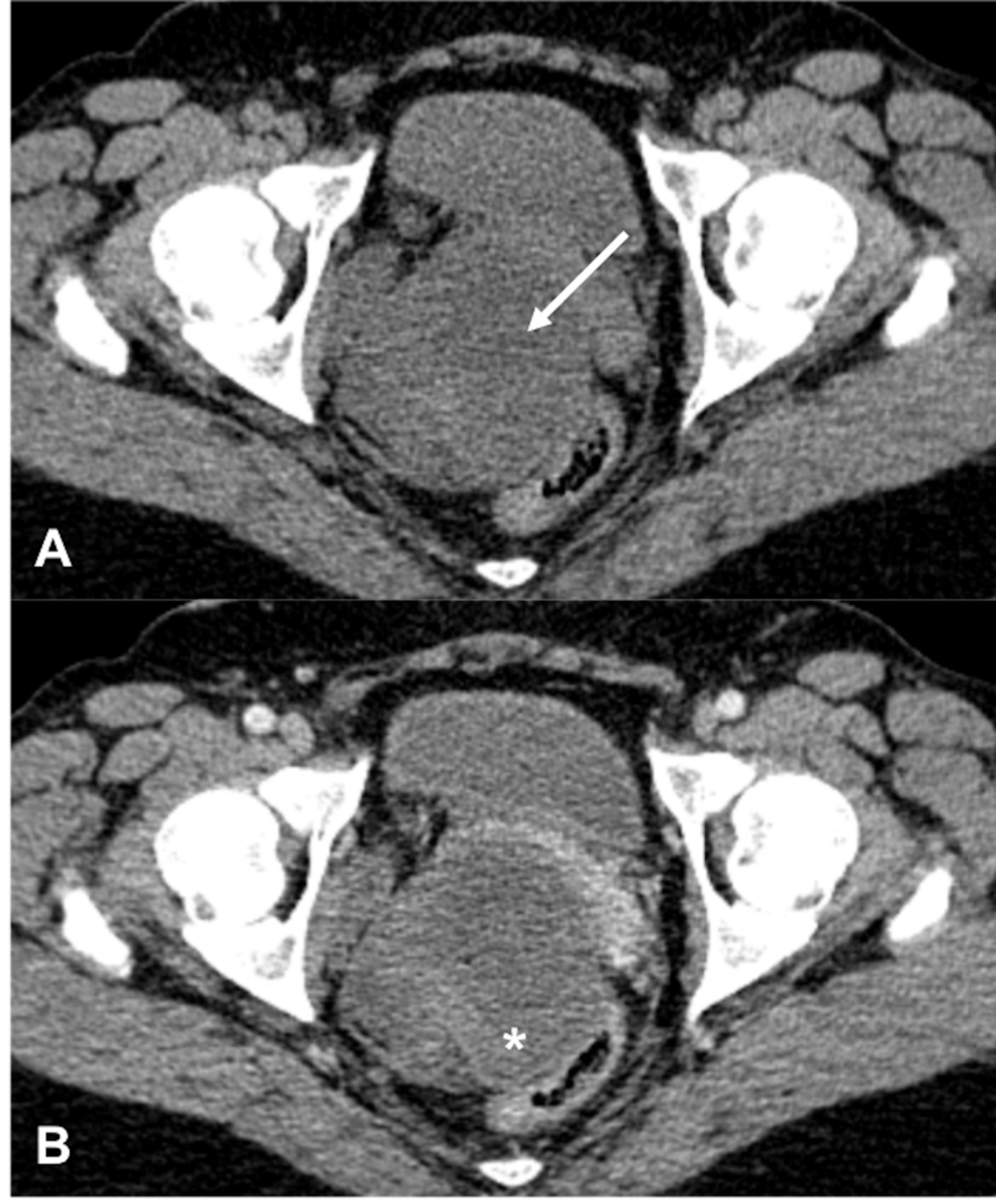 Recurrent Deep (Aggressive) Angiomyxoma of the Pelvis: Serial MRI Documentation of Sustained Complete Radiologic Response During Eight Years of Gonadotropin-Releasing Hormone (GnRH) Agonist Therapy