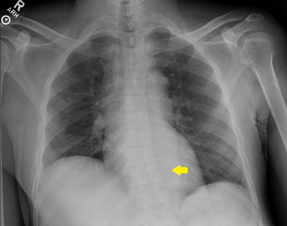 cureus-venous-stent-migration-into-right-ventricle