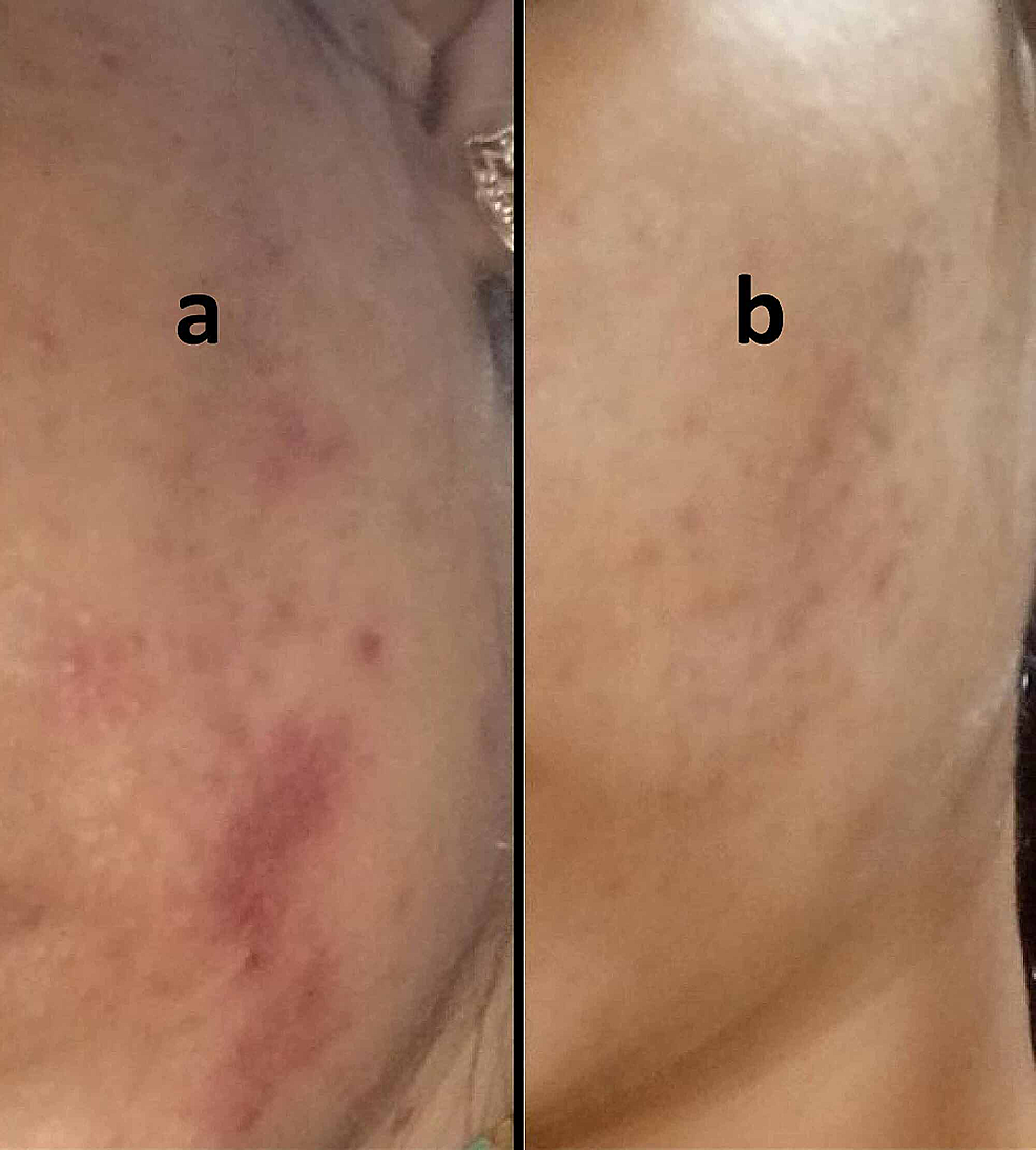 Exacerbation-of-signs-and-symptoms-after-starting-medications-for-acne,-and-nearly-complete-resolution-after-starting-antifungals.-(a)-Increased-erythema-with-burning-sensation-over underlying-lesions-on-the-face-reported-after-topical-application-of-clindamycin-tretinoin-and-intake-of-oral-antibiotics-for-a-provisional-diagnosis-of-acne-vulgaris.-(b)-Lesions-showed-significant-resolution-after-a-course-of-topical-and-oral-antifungals.