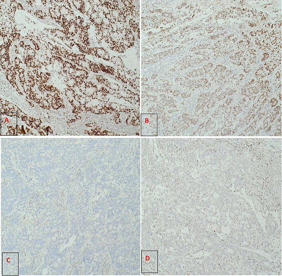 -(A)-Colonic-tumour-strongly-positive-for-MSH6-9-(MutS-homolog-6-9)x10,-(B)-week-staining-for-MSH2-(MutS-homolog2)-x10,-(C)-MLH1-(MutL-homolog-1)-is-completely-negative-x10,-(D)-PMS2-(PMS1-Homolog-2)-completely-negative-x10.-Note:-The-positive-–-brown-cells-in-the-background-of-(D)-are-lymphoid-cells.