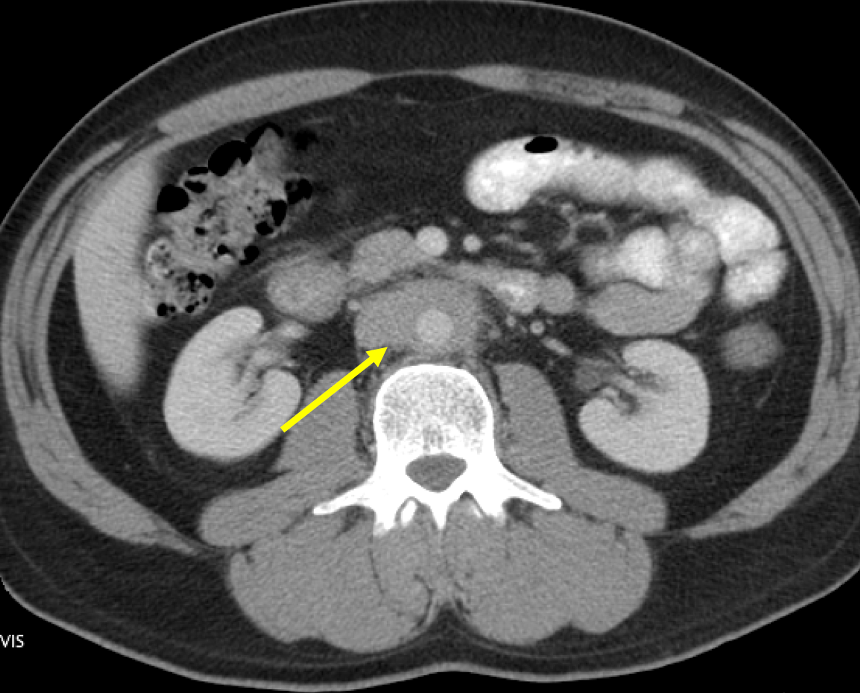 Cureus Atypical Presentation Of Idiopathic Retroperitoneal Fibrosis ...