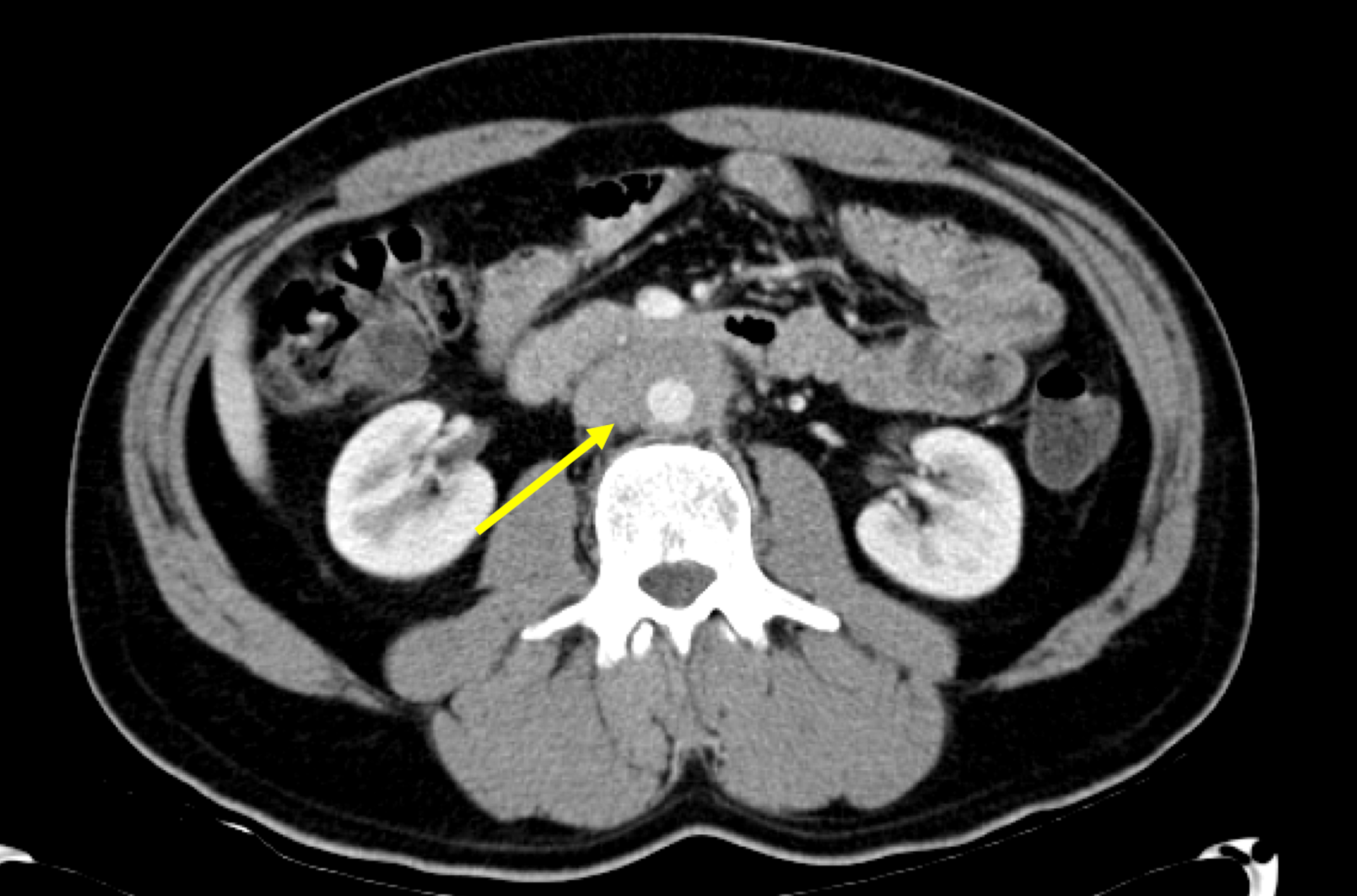 Cureus Atypical Presentation Of Idiopathic Retroperitoneal Fibrosis