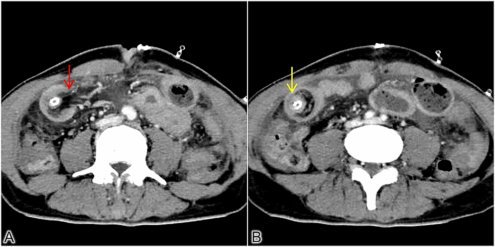 Cureus Antegrade Jejunojejunal Intussusception An Unusual Complication Following Feeding