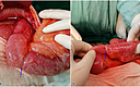 Cureus Antegrade Jejunojejunal Intussusception An Unusual