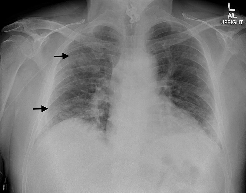 Daptomycin-Induced Acute Eosinophilic Pneumonia | Cureus