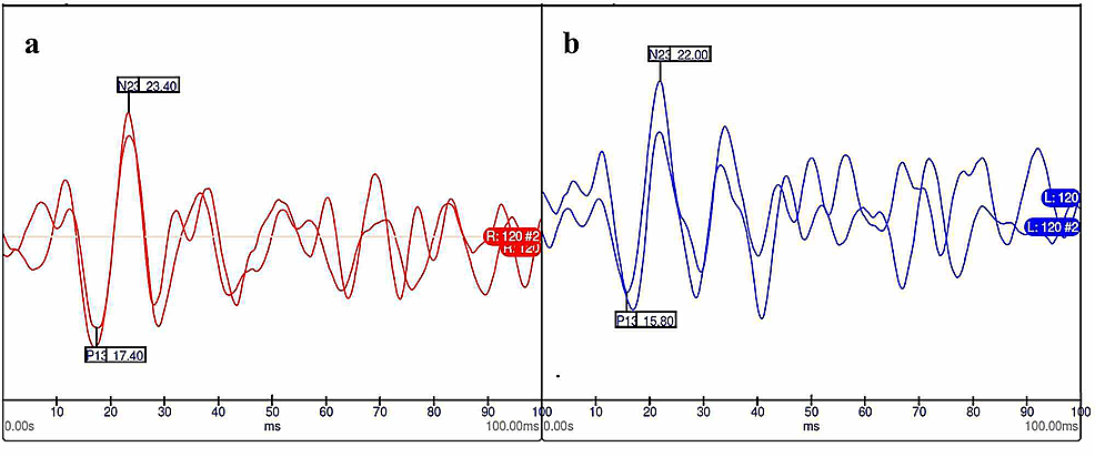 Cervical-vestibular-evoked-myogenic-potentials.