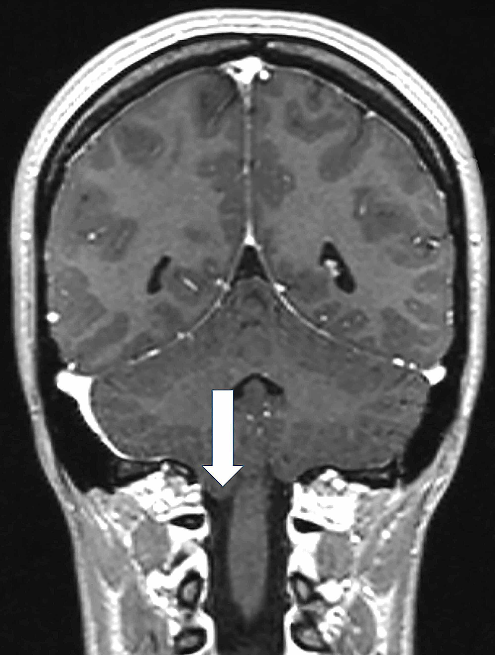 Coronal-brain-MRI.