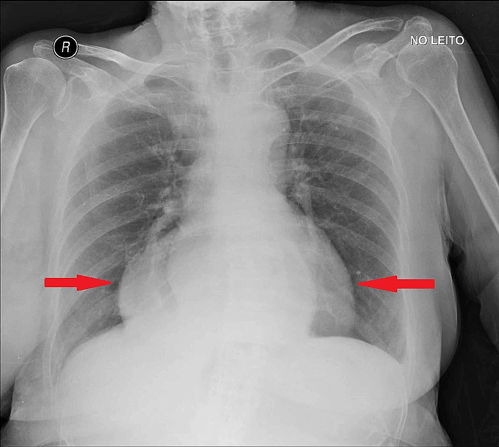 cureus-gastric-volvulus-a-multidisciplinary-approach-and