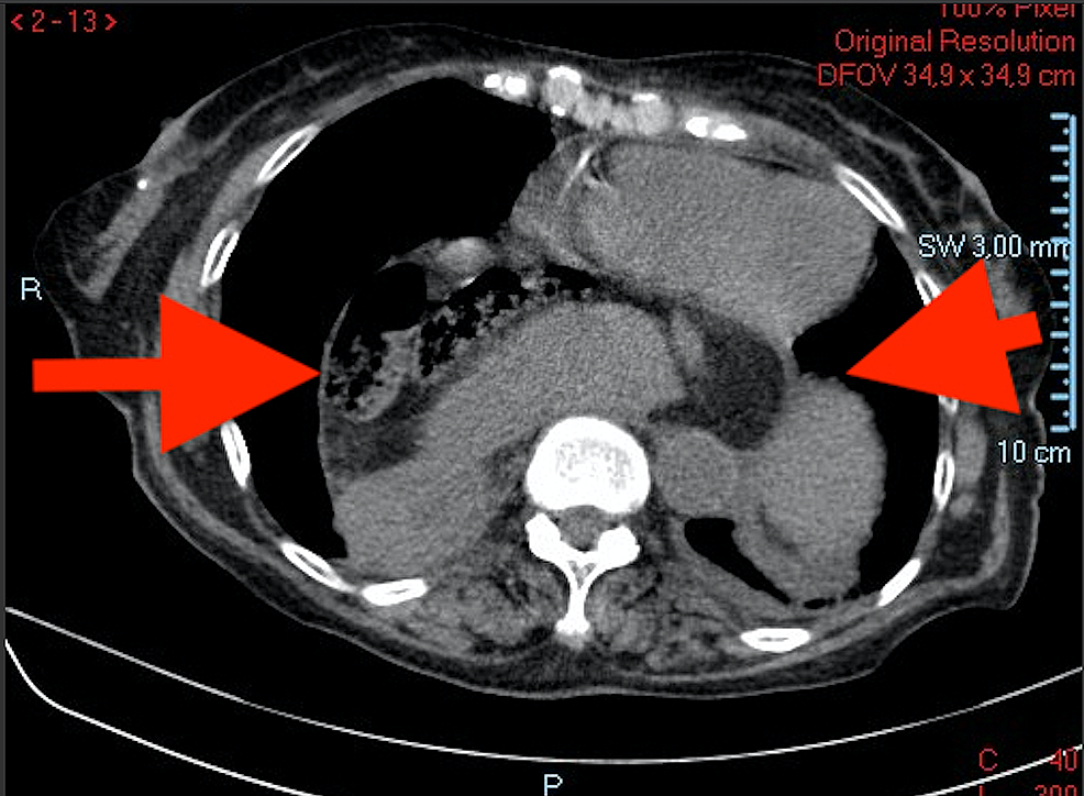 Cureus Gastric Volvulus A Multidisciplinary Approach and Conservative Treatment