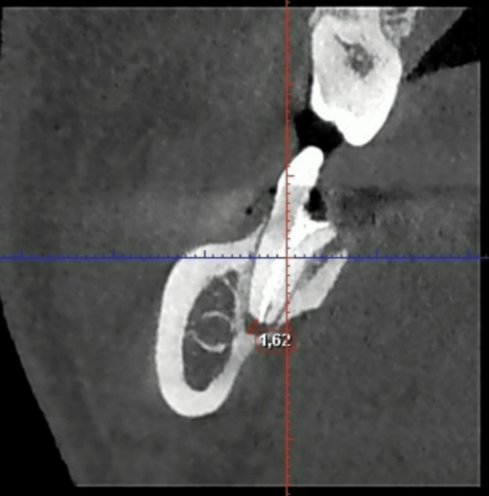 Er:YAG Laser-Assisted Root Canal Decontamination in Post