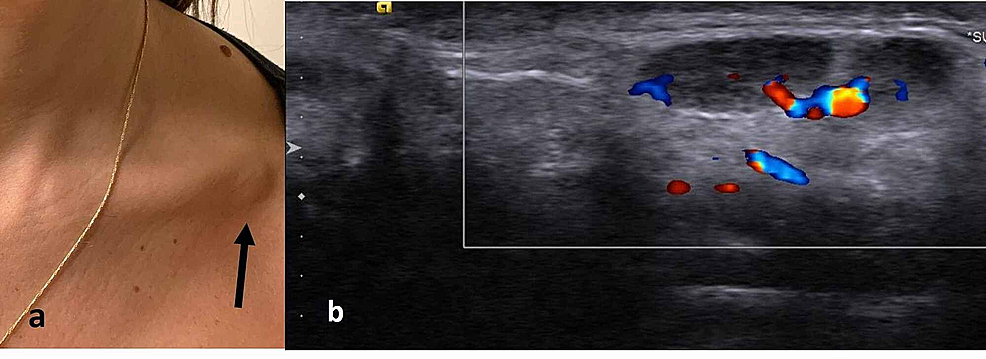 (a)-Focal-swelling-in-the-left-infraclavicular-area-that-prompted-the-study-(arrow).-(b)-Ultrasound-image-of-the-area-demonstrating-enlarged-lymph-nodes-with-a-slightly-hypoechoic-cortical-layer-but-with-preserved-hilum-and-blood-supply.