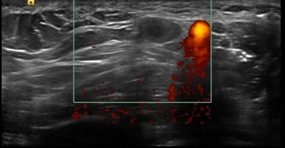 Ultrasonographic-image-demonstrating-hypoechoic-lymph-nodes-without-blood-flow,-adjacent-to-the-axillary-vein.