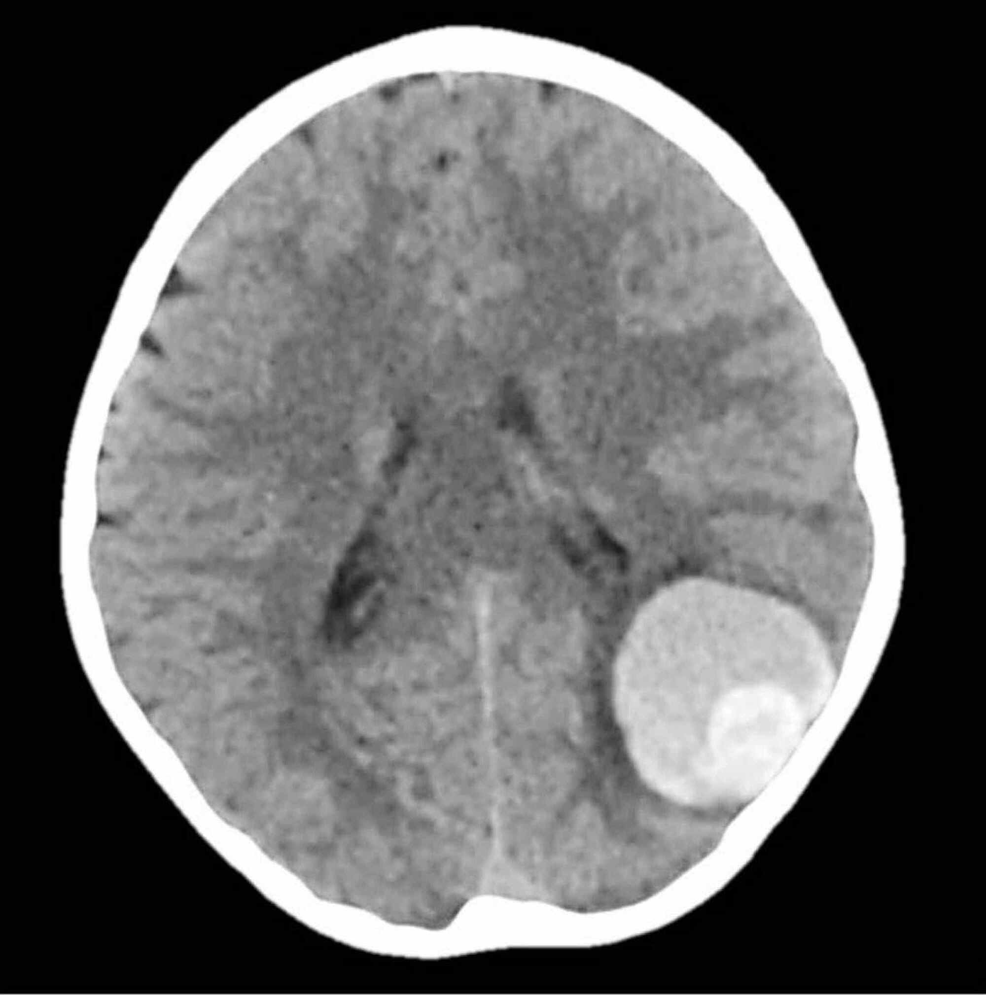 brain hemorrhage scan