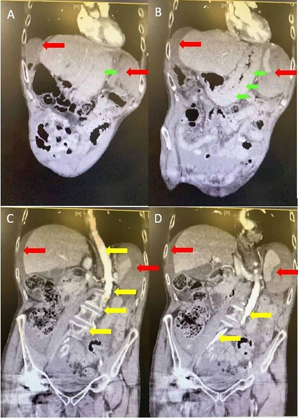 cureus-a-case-of-iatrogenic-splenic-injury-following-routine