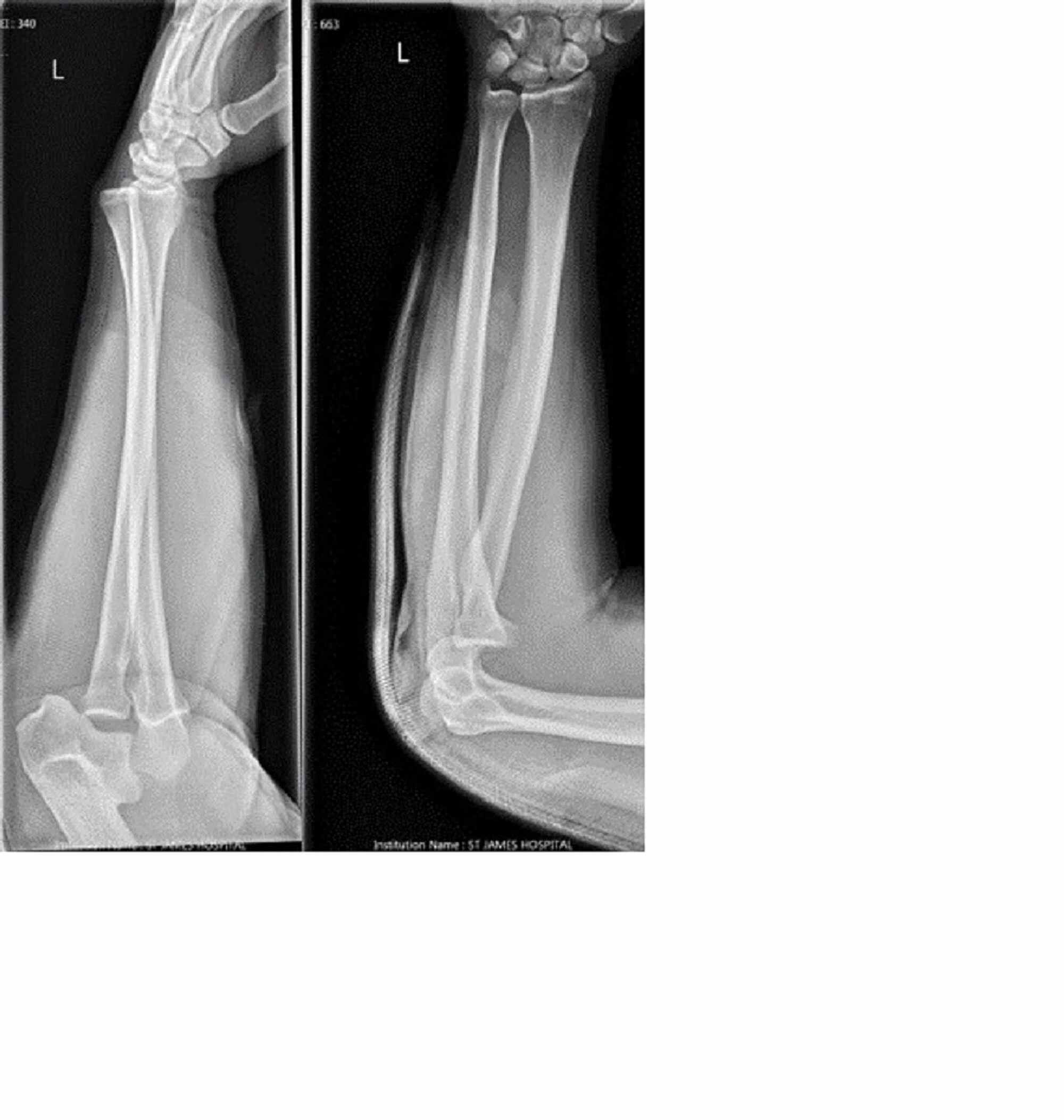 Cureus | An Unusual Case of Anterior Elbow Dislocation Without Bony Injury