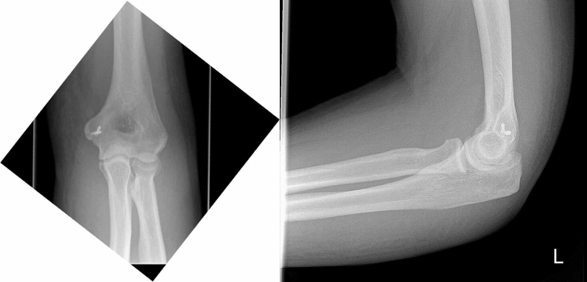 Cureus | An Unusual Case of Anterior Elbow Dislocation Without Bony Injury