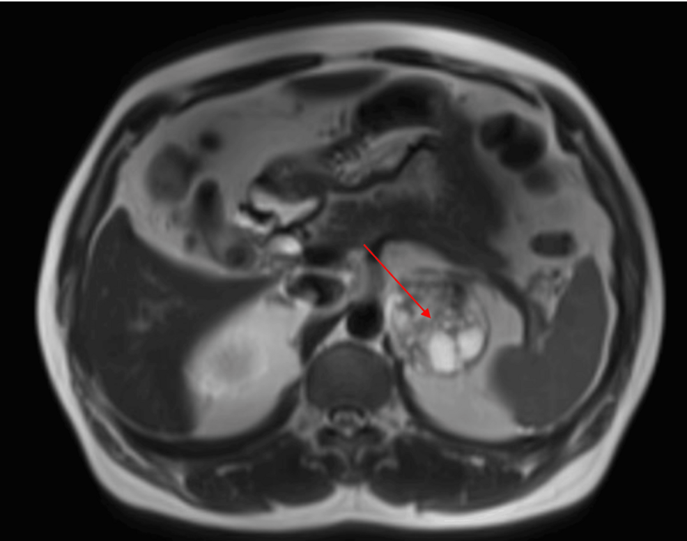 To Resect or Not to Resect: An Incidental Finding of an Adrenal