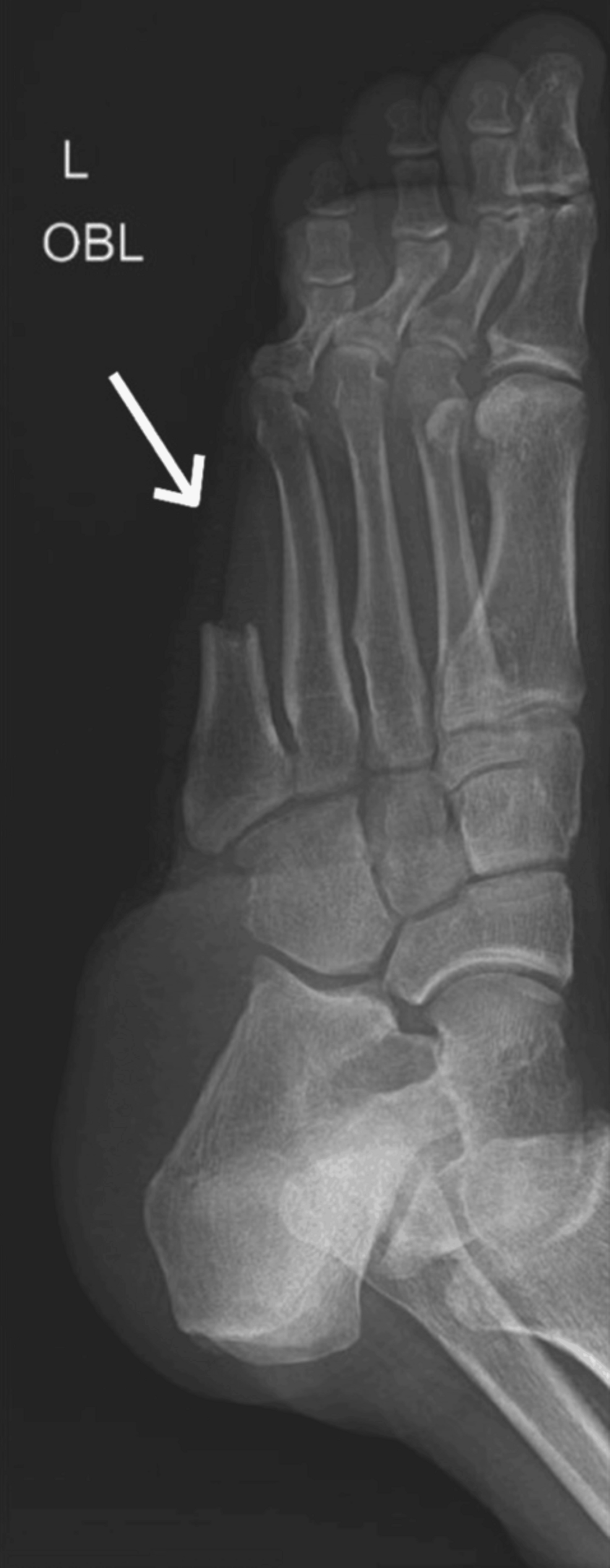 Splenic Rupture & Klebsiella: A Diabetic Patient Case Report