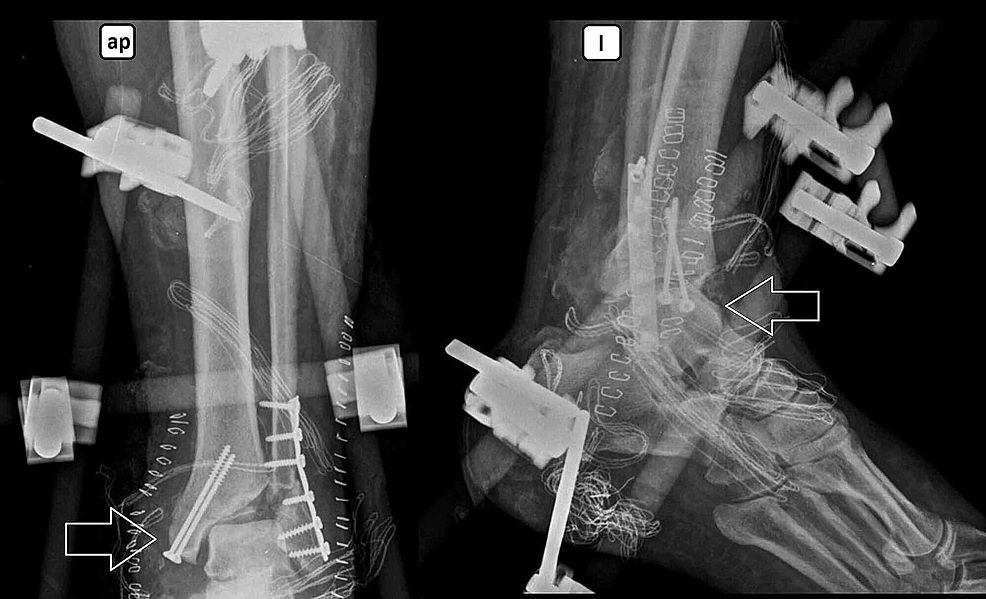 ankle surgery open reduction internal fixation ankle surgery open reduction internal fixation
