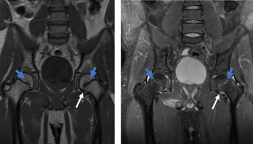 Cureus | Slipped Capital Femoral Epiphysis as a Presentation of ...