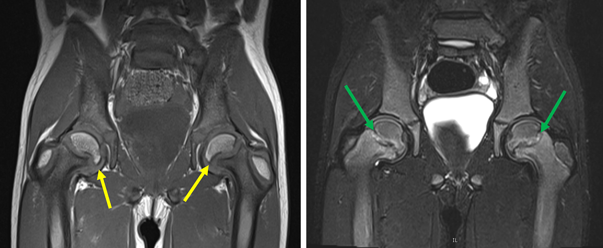 Cureus | Slipped Capital Femoral Epiphysis as a Presentation of ...