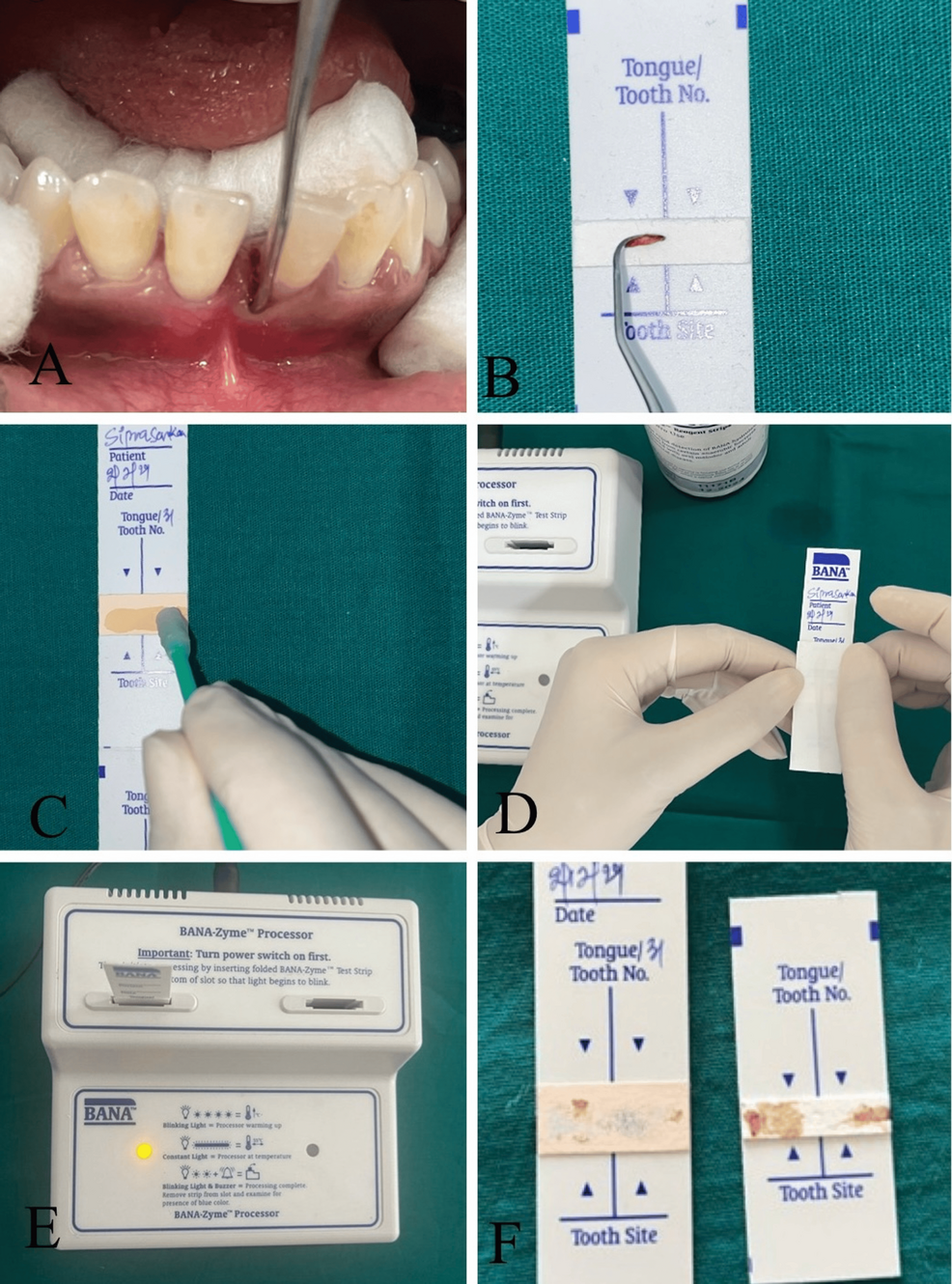 Association of the Red Complex Bacteria in Endo-Perio Cases Before