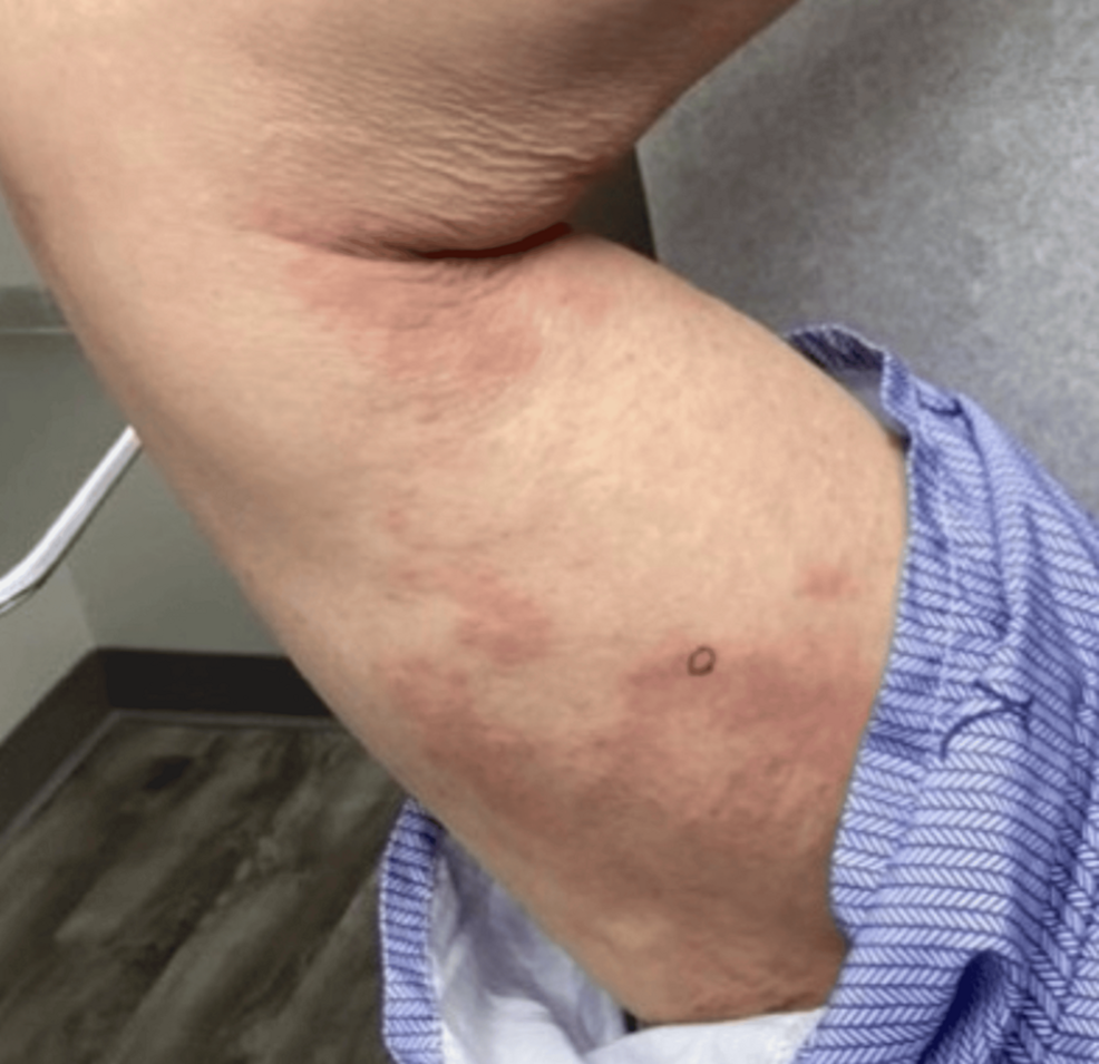 Annular Elastolytic Giant Cell Granuloma in a Post-COVID-19 Patient: A Case Report - News Directory 3