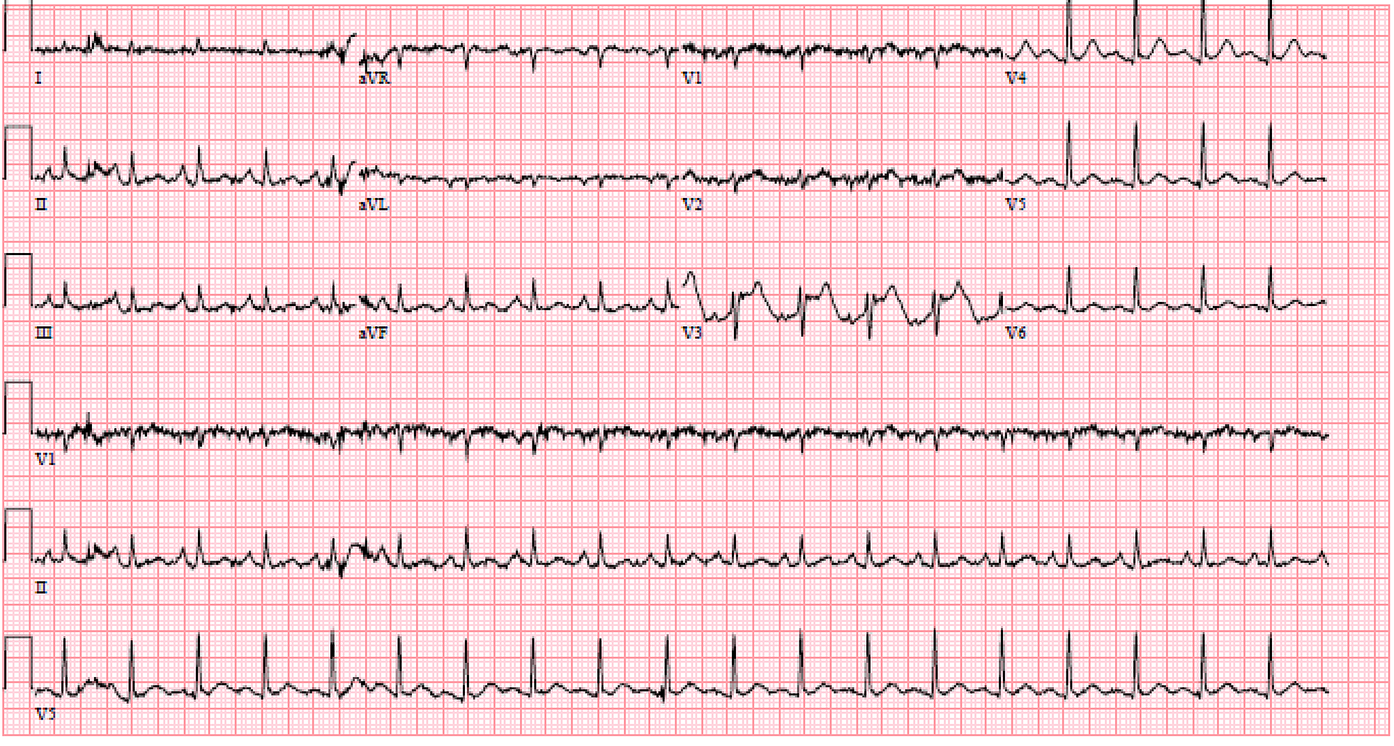 Cureus Medical Management Of Heparin Induced Thrombocytopenia Causing Acute Adrenal Insufficiency