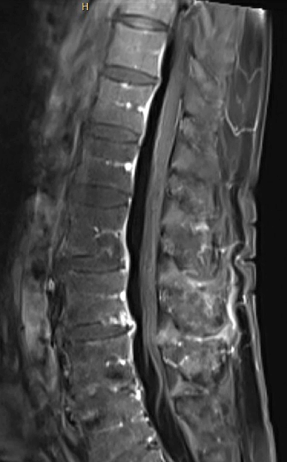 -MRI-lumbar-spine-with-contrast-